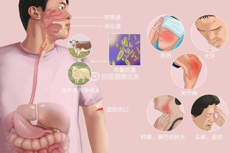 布鲁氏菌病防治技术规范有何关键要点？-图1